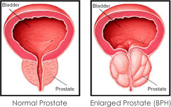 pro_prostate