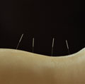 Acupuncture for low back pain in Phoenix and Scottsdale
